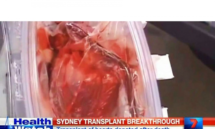 Prva transplantacija mrtvog srca u Australiji