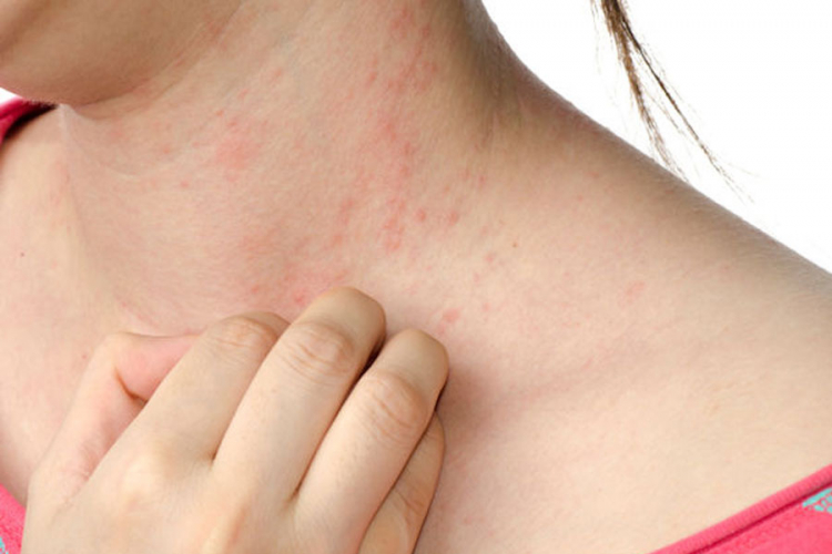 Alergije napunile domove zdravlja u RS