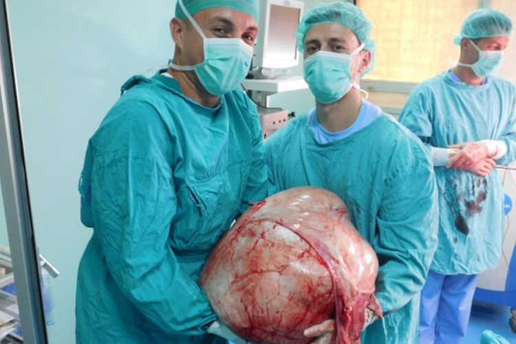 Banjalučki doktori odstranili tumor težak 31 kilogram (FOTO)