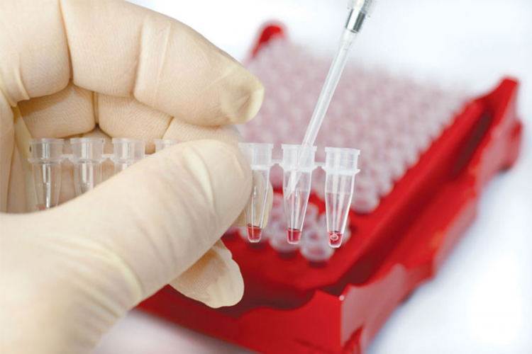 Naučnici: Analizom krvi moguće otkriti rak
