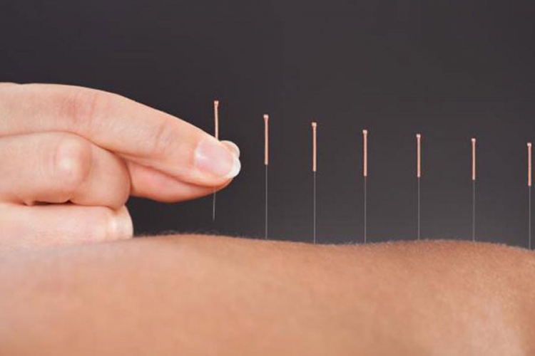 Naučnici bijesni zbog akupunkture na bebama