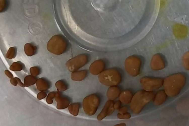 Petomjesečnoj bebi iz bubrega izvađeno 56 kamenčića
