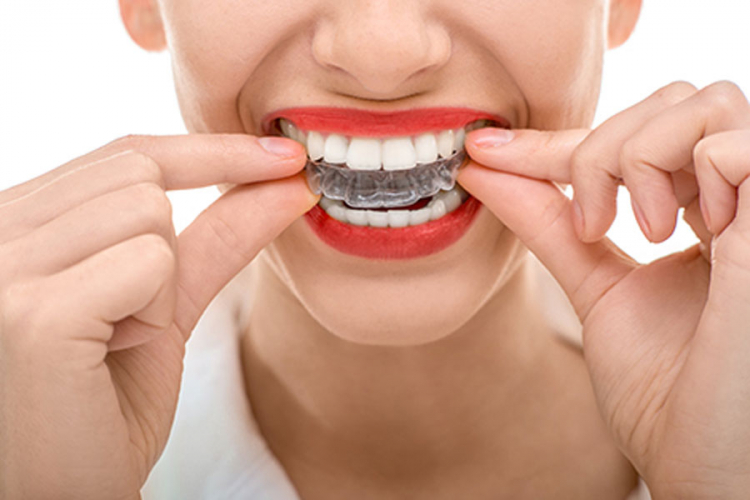 Zamjena za klasične proteze: Nevidljive zubne folije za ljepši osmijeh