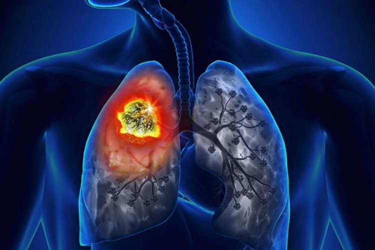 Sve više oboljelih od raka pluća u TK, zagađen vazduh jedan od glavnih uzroka