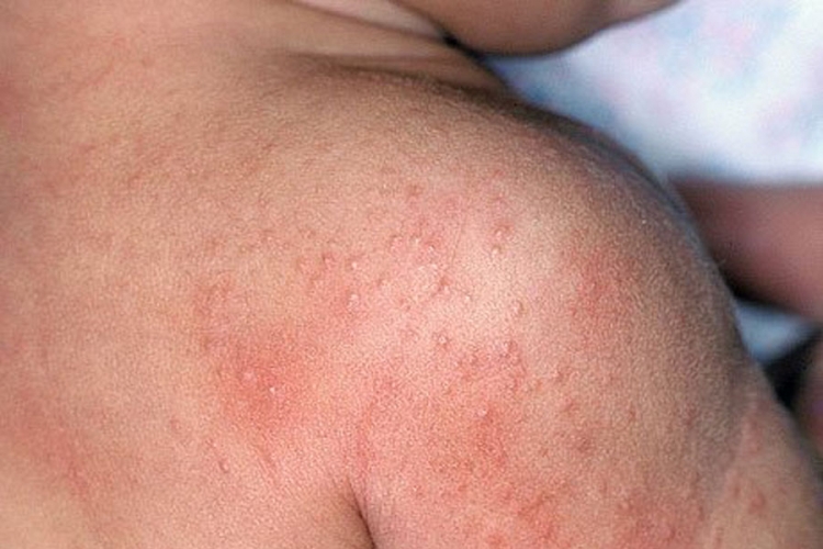 Virusom herpesa protiv raka kože