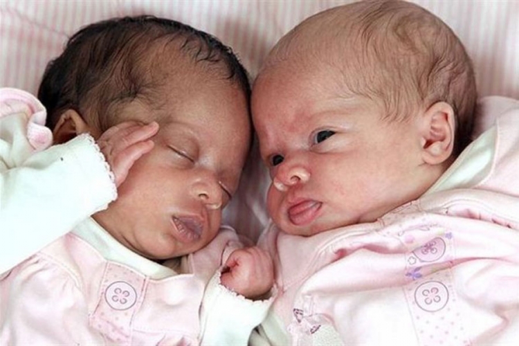 Britanka rodila blizanke različitih boja kože