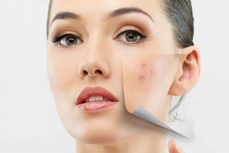 Prirodan tretman koji će izbrisati akne i ožiljke sa vašeg lica