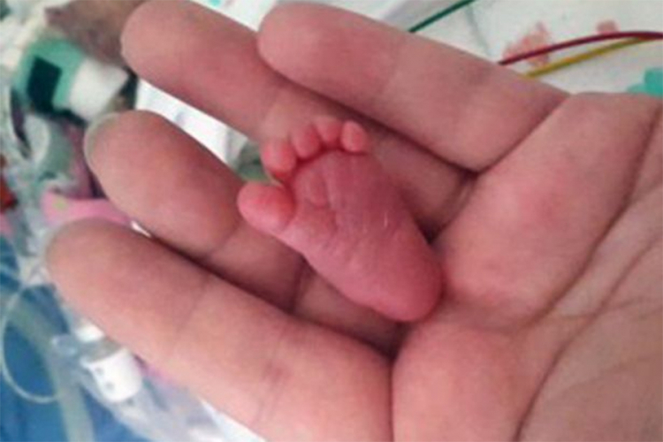 Beba koja se rodila teška samo 400 grama se izborila za život