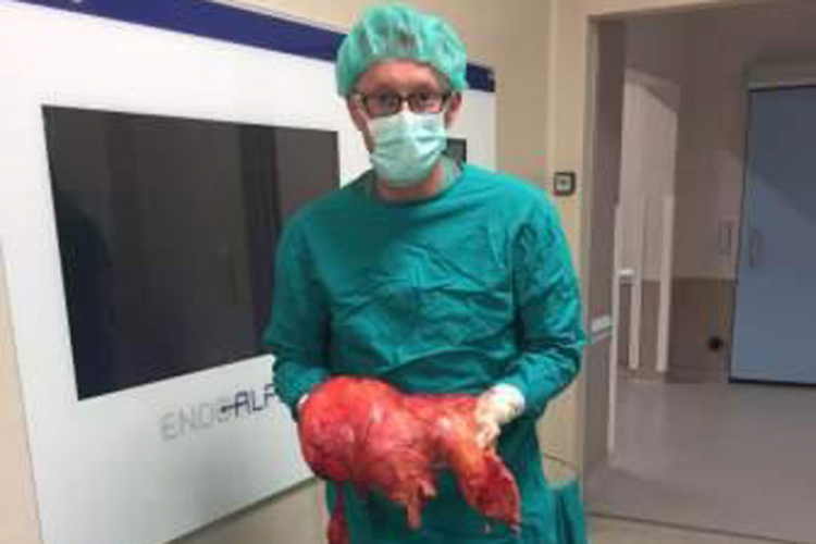 U Kliničkom centru Univerziteta Sarajevo odstranjen tumor od 11,4 kilograma