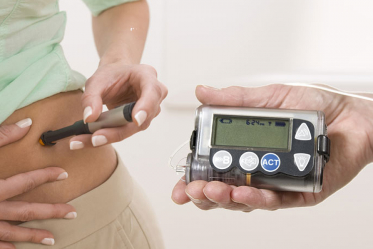 FZO RS dijabetičarima plaća insulinske pumpe