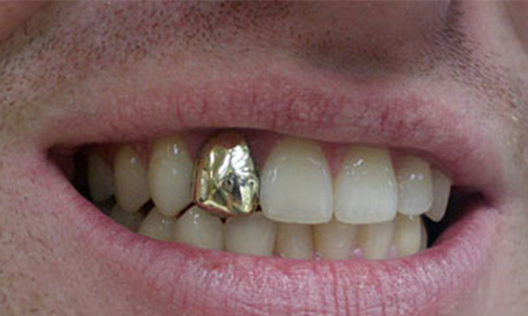 Ženi iz usta ukrali zubnu protezu