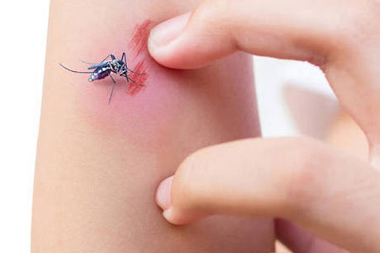 Kako da ublažite svrab poslije uboda komarca
