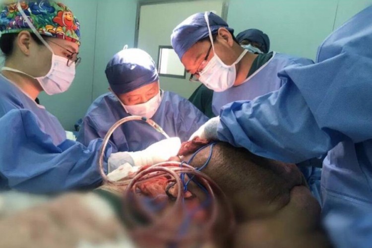 Sto hirurga 33 sata otklanjalo tumor od 28 kg (ŠOKANTNE FOTOGRAFIJE)