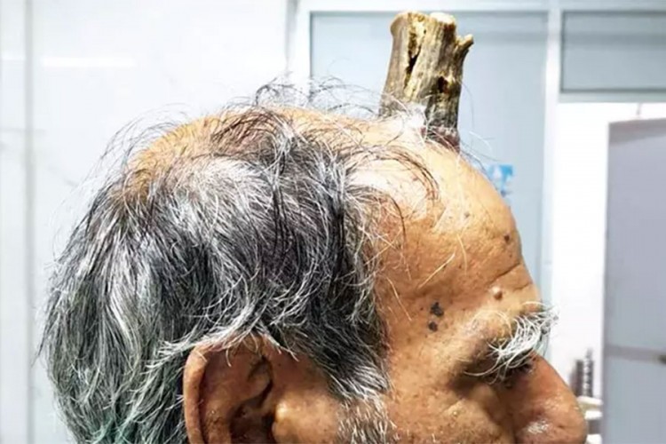 Hirurzi muškarcu iz Indije uklonili rog od deset centimetara