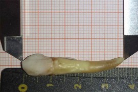 Oboren Ginisov rekord, Hrvatu izvađen zub dug 37,2 milimetra