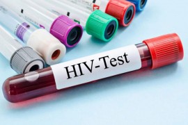 Besplatno testiranje na HIV u UKC RS