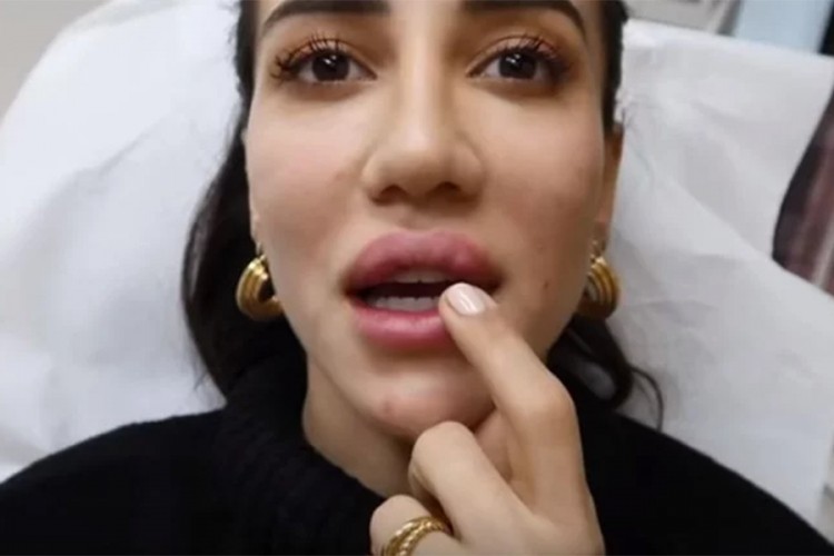 Srpska influenserka pokazala kako joj uklanjaju filere iz usana