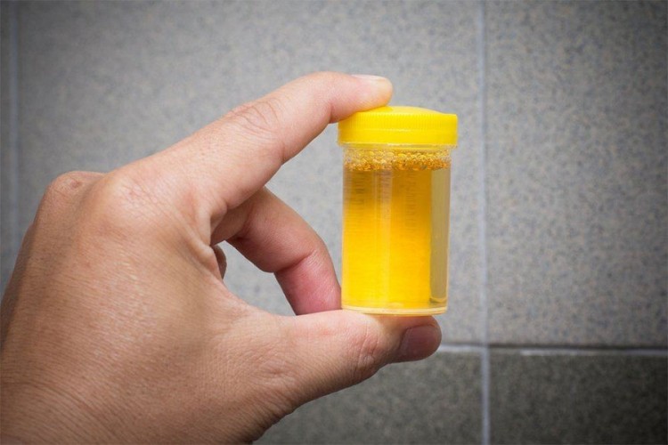 Boja urina otkriva dosta o vašem zdravlju