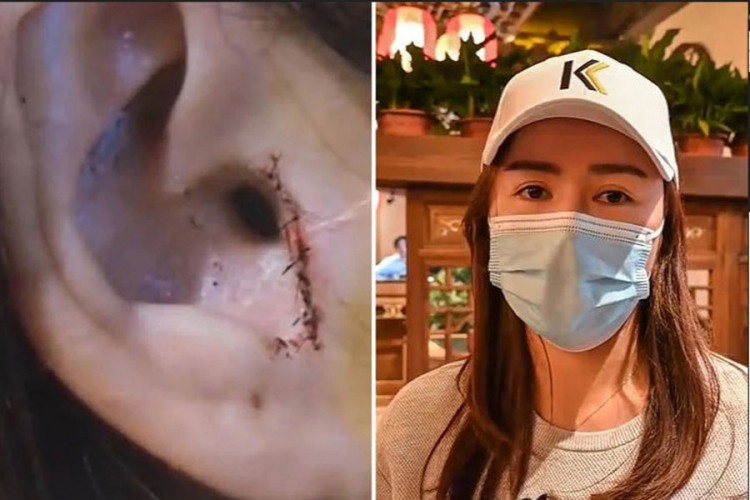 Kineskinji nakon operacije nosa nedostaje dio uha