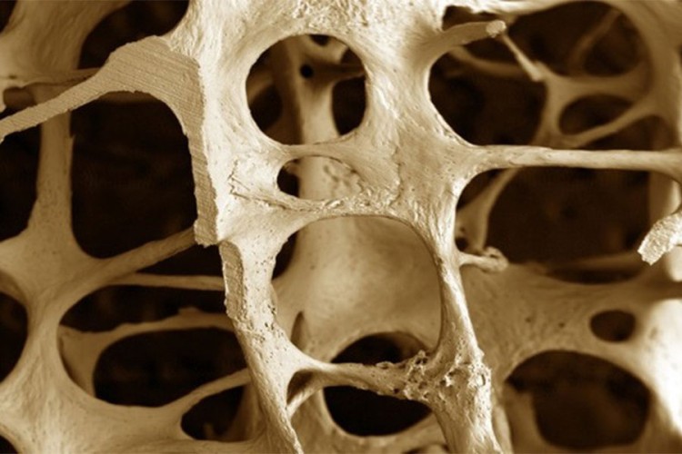 Osteoporoza - jedna od pet najčešćih hroničnih bolesti