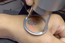 Kako izgleda uklanjanje tetovaže