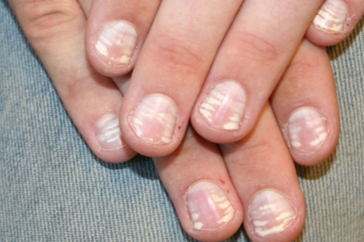 Šta znače bijele tačkice na noktima?