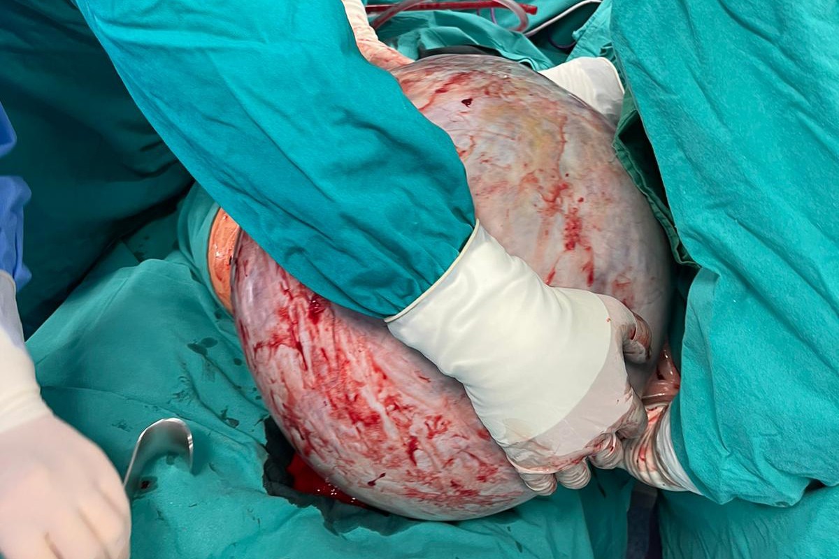 Detalji operacije u Banjaluci: Tumor težak 23 kilograma uklanjali dva i po časa (FOTO)