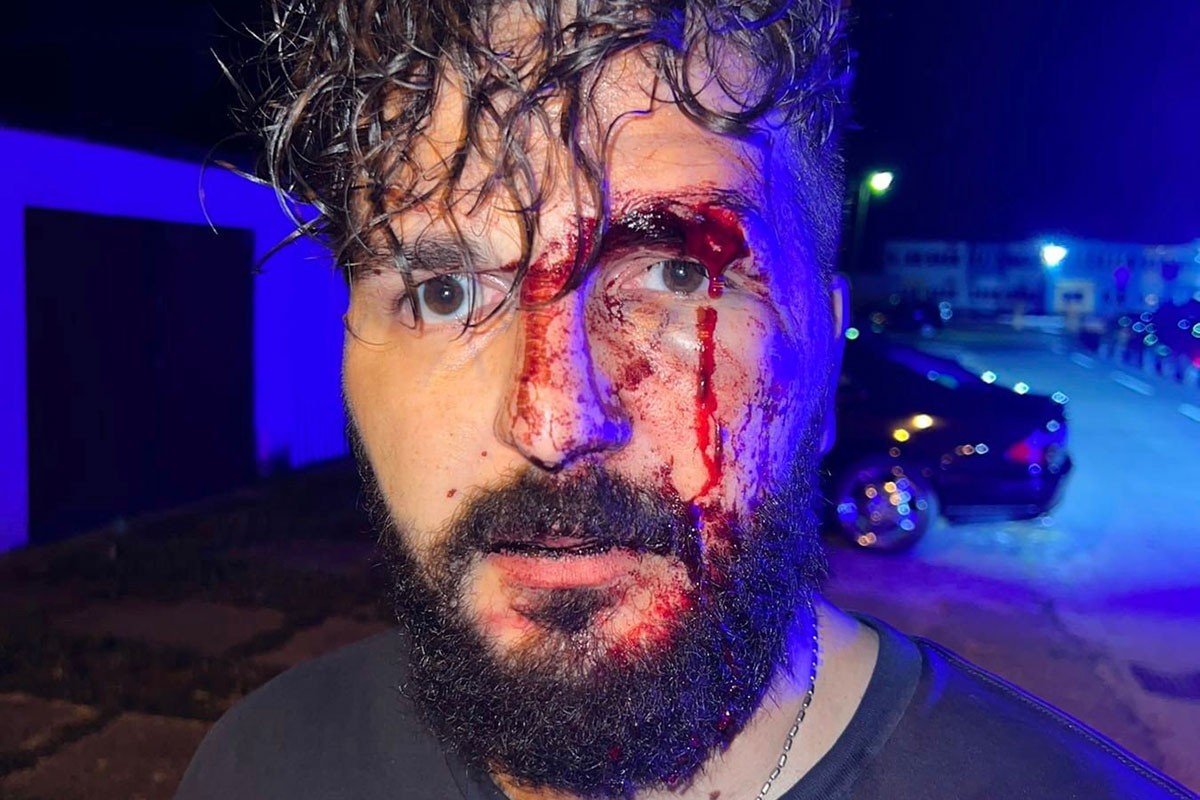 Novinar iz Brčkog u sačekuši napadnut i pretučen (FOTO)