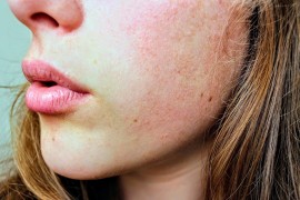 Kako ukloniti dlačice iznad usana?