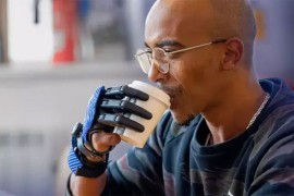 Upoznajte prvog čovjeka sa 3D štampanim bioničkim prstima