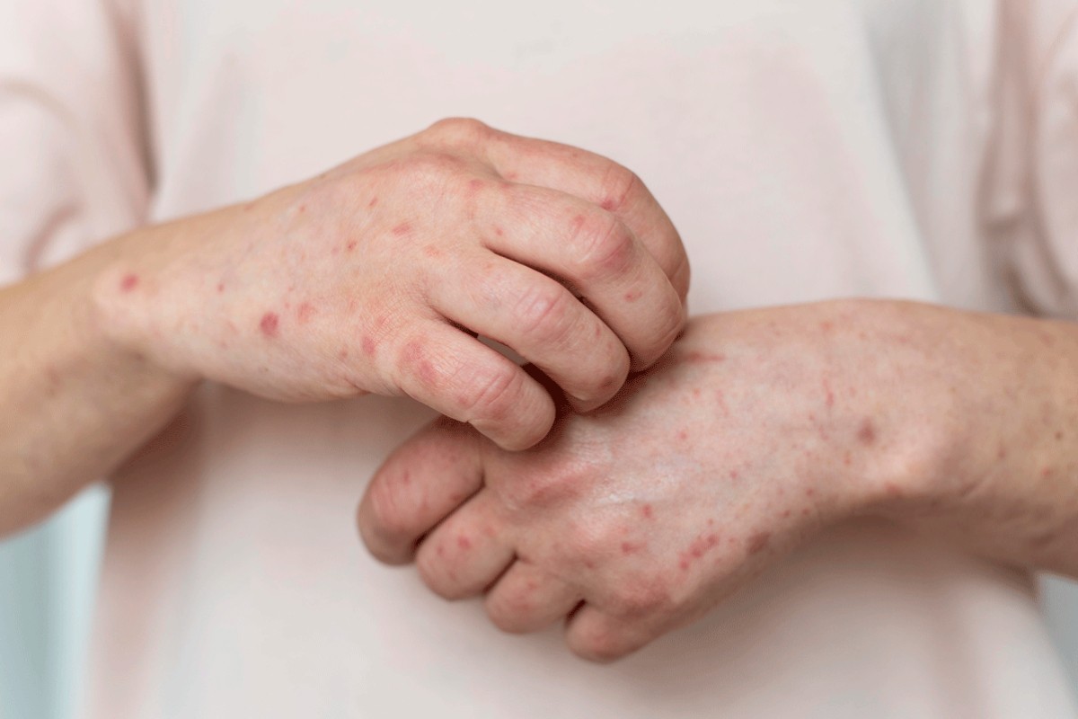 Najveća epidemija ospica u posljednjih 30 godina