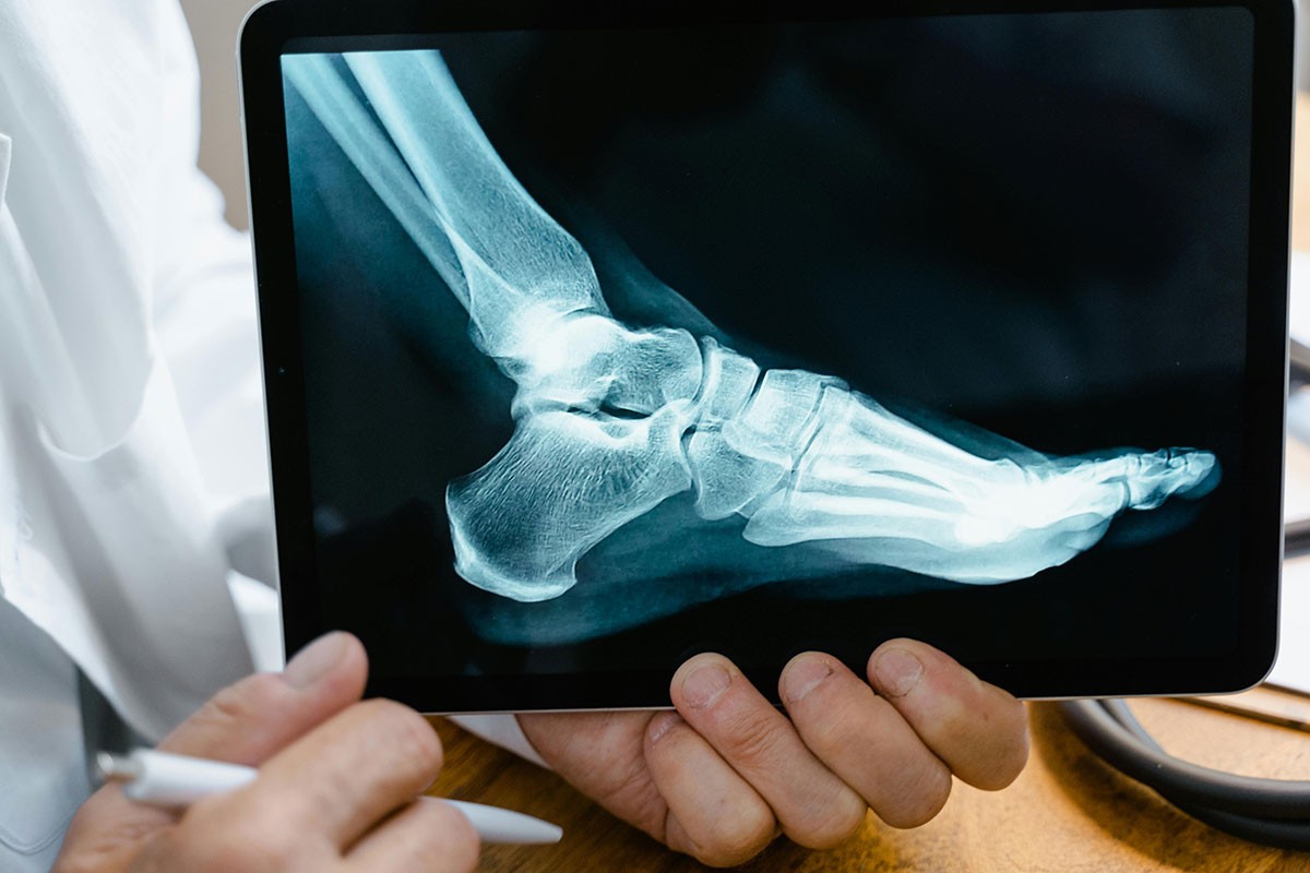 Ovako izgleda napad gihta: Doktor objašnjava kako se liječi to bolno stanje
